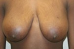 Breast Lift (Mastopexy)