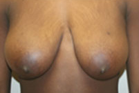 Breast Lift (Mastopexy)