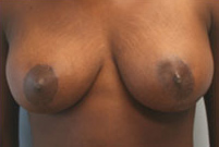 Breast Lift (Mastopexy)