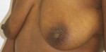 Breast Lift (Mastopexy)