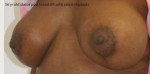 Breast Lift (Mastopexy)