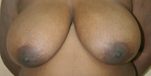 Breast Lift (Mastopexy)
