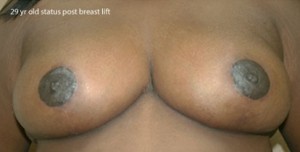 Breast Lift (Mastopexy)