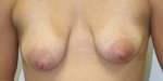 Breast Lift (Mastopexy)