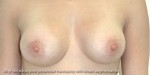 Breast Lift (Mastopexy)
