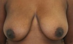 Breast Lift (Mastopexy)
