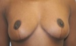 Breast Lift (Mastopexy)