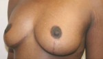 Breast Lift (Mastopexy)