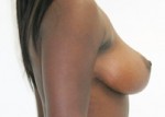 Breast Lift (Mastopexy)