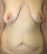 Breast Lift (Mastopexy)