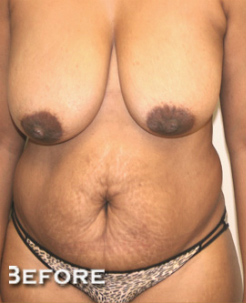 Breast Lift (Mastopexy)