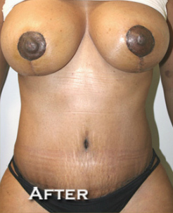 Breast Lift (Mastopexy)
