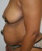 Breast Lift (Mastopexy)