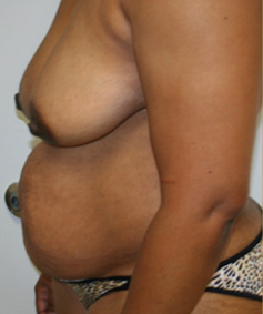 Breast Lift (Mastopexy)