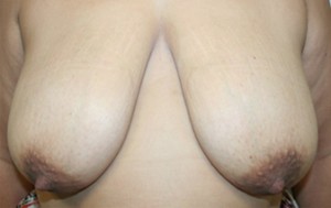 Breast Lift (Mastopexy)