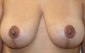 Breast Lift (Mastopexy)