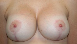Breast Lift (Mastopexy)