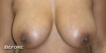 Breast Lift (Mastopexy)