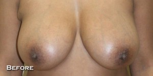 Breast Lift (Mastopexy)