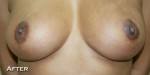 Breast Lift (Mastopexy)