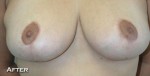 Breast Lift (Mastopexy)