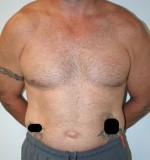 Liposuction