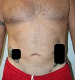 Liposuction