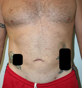 Liposuction