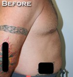 Liposuction