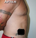 Liposuction