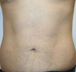 Liposuction