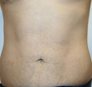 Liposuction