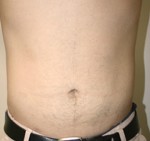 Liposuction