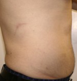 Liposuction