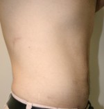 Liposuction