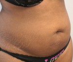 Liposuction