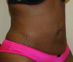 Liposuction