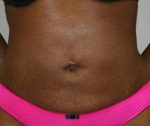 Liposuction
