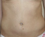 Liposuction