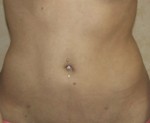 Liposuction