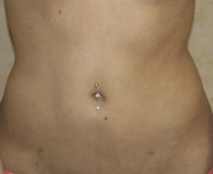Liposuction