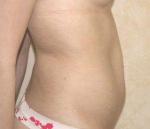 Liposuction