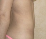 Liposuction