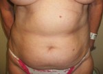 Liposuction
