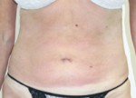 Liposuction