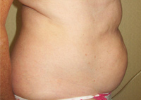 Liposuction