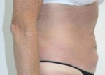 Liposuction