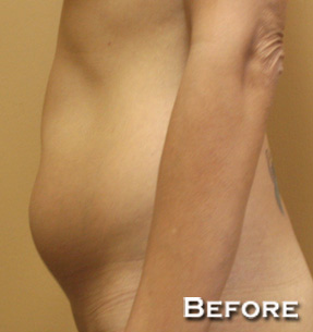 Liposuction
