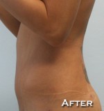 Liposuction