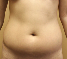 Liposuction